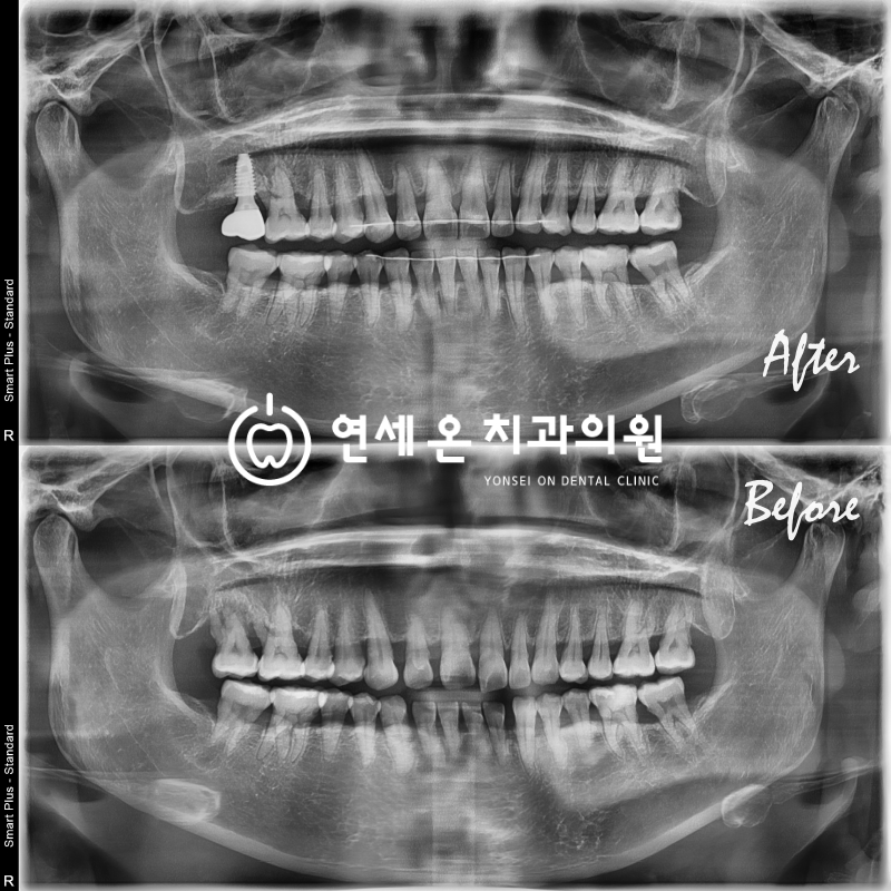 중년층투명교정엑스레이