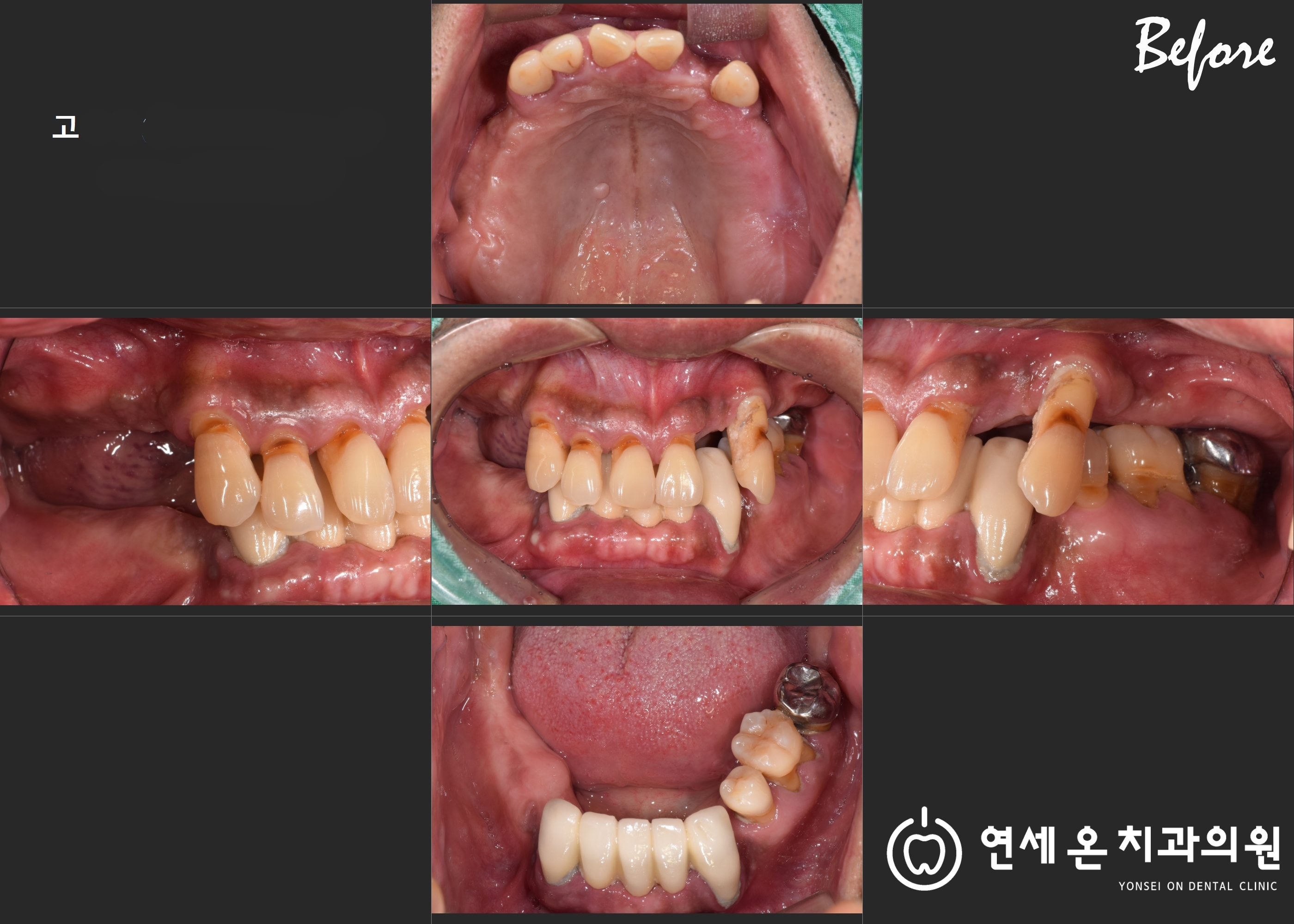 50대 남성 - 전체임플란트