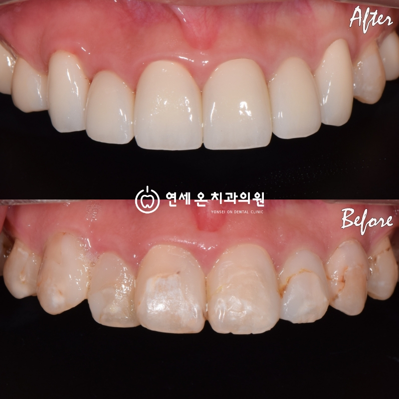 풀지르코니아(full zirconia) 크라운(crown)심미보철